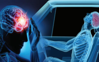 Can I Sue for a Concussion After a Rear-End Collision in NY?