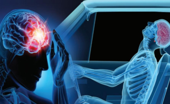 X-ray style illustration of a driver’s head snapping back in a car seat and a glowing brain injury, showing how a rear-end collision can cause a concussion