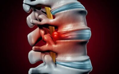 What’s the Average Settlement for a Herniated Disc From a Car Accident in NY?