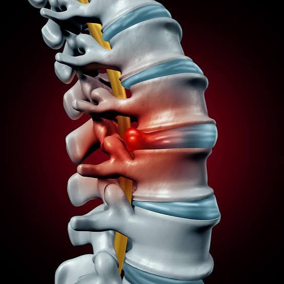 3D illustration of the lower spine with a herniated disc bulging out and pressing on a spinal nerve, the kind of injury often caused by a car accident in New York